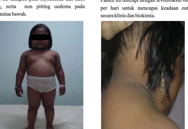 Gambar 1. Seorang anak perempuan usia 7 tahun dengan tinggi badan 92 cm, relatif gemuk, ekspresi wajah datar, myxedema dan kulit kering.