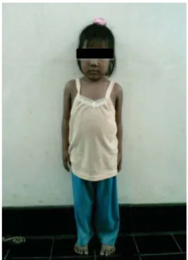 Gambar  5. Kondisi pasien setelah menjalani terapi selama 3 bulan. Berat badannya menjadi 17 kg dan tingginya 95 cm.