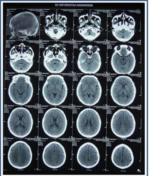 Gambar  2.  CT  Scan  Kepala  Non  Kontras  :    tidak  tampak  lesi  intracranial,  retension cyst sinus maxillaris sinistra 
