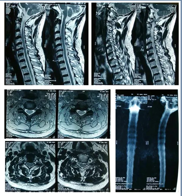 Gambar 3. MRI Cervical :  Degenerative disc pada semua level cervical, Protusion disc pada  level C3-C4 central type, menekan thecal sac dan spinal cord di  posteriornya, Bulging disc  pada  level  C5-C6  broadbased  type,  menekan  thecal  sac  dan  reces