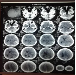 Gambar 1. CT-Scan Kepala Tanpa Kontras  Pasien  didiagnosis  berdasarkan  anamnesis,  pemeriksaan  fisik  dan  pemeriksaan  penunjang  maka  ditegakkan  diagnosa  cephalgia  et  causa  hematom  subdural  kronik