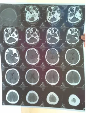 Gambar 1. CT Scan Kepala Pasien 