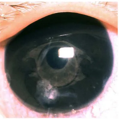 Gambar 2.7. Mutiara Elschnig  Sumber : (American Academy of Ophthalmology, 2007). 