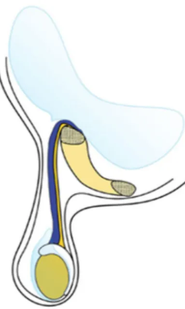 Gambar  2.  Hidrokel  komunikan  yang  terjadi  ketika  terjadi  patentprocessus  vaginalis  sepanjang  kanalis  inguinalis 