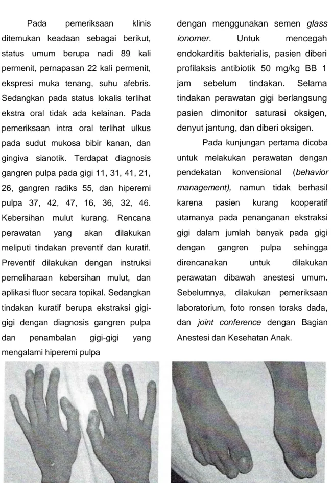Gambar 1. Jari-jari tangan dan kaki pasien yang clubbing dan sianotik (pasien 1)