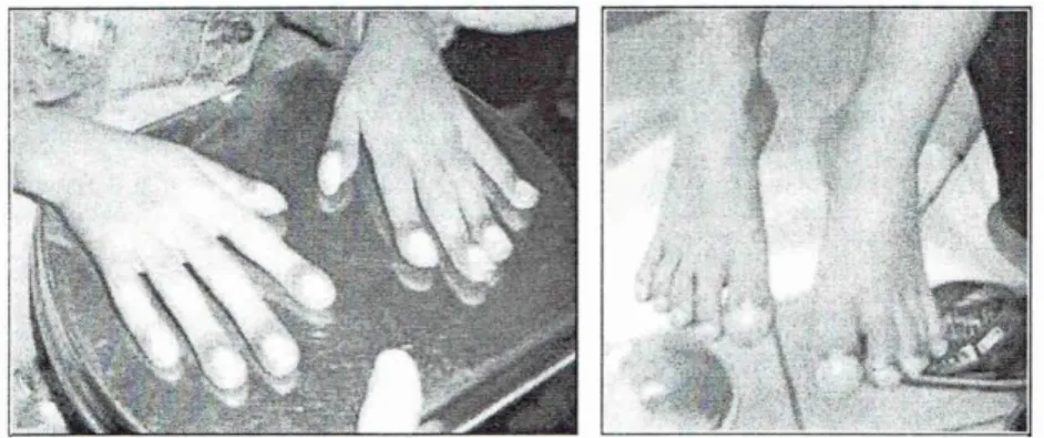 Gambar 5. Ujung jari-jari dan tangan yang sianotik dan clubbing (pasien 2)