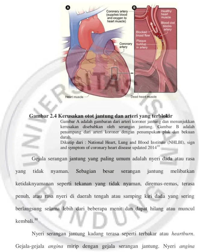 Gambar A adalah gambaran dari arteri koroner jantung dan menunjukkan  kerusakan  disebabkan  oleh  serangan  jantung