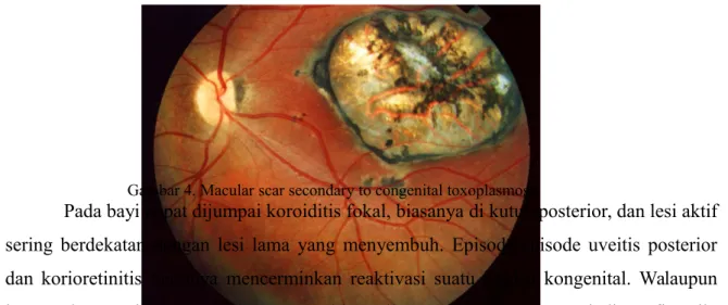 Gambar 4. Macular scar secondary to congenital toxoplasmosis