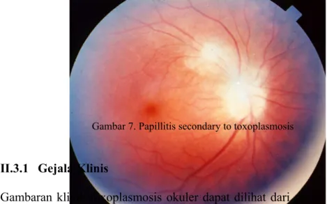 Gambar 6. Acute macular retinitis associated with primary acquired toxoplasmosis