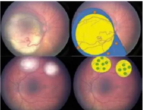 Gambar 7  Retinoblastoma Grup C