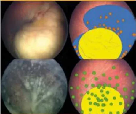 Gambar 8  Retinoblastoma Grup D