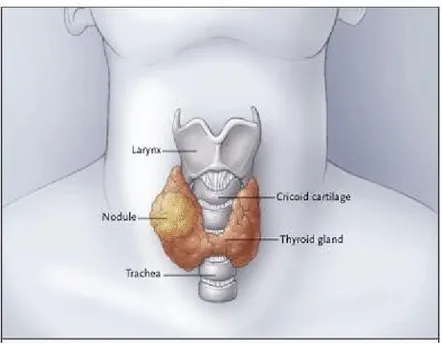 Gambar 1. Nodul Pada glandula tiroid