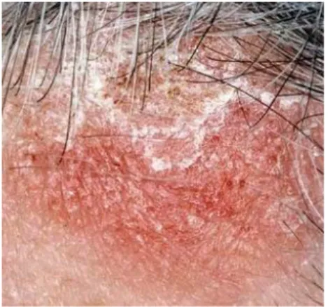 Gambar 10: Gambaran Kelainan Dermatitis Seboroik Pada Skalp Pasien Dermatitis Seboroik ( Seborrhoeic Dermatitis, Seborrheic Dermatitis ) merupakan  peradangan permukaan kulit berbentuk lesi squamosa (bercak disertai semacam sisik), bersifat kronis, yang se