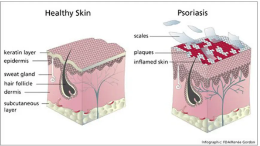 Gambar 4: Pembandingan Proliferasi Kulit Yang Sehat Dengan Kulit Psoriasis Pada psoriasis pembentukkan epidermis (turn over time) lebih cepat, hanya 3-4 hari,  sedangkan pada kulit normal lamanya 27 hari