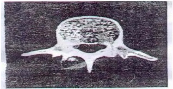 Gambar 4. CT Scan pada vertebra lumbal