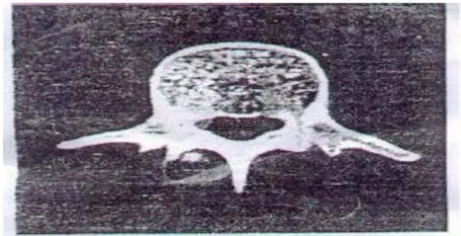 Gambar 4. CT Scan pada vertebra lumbal