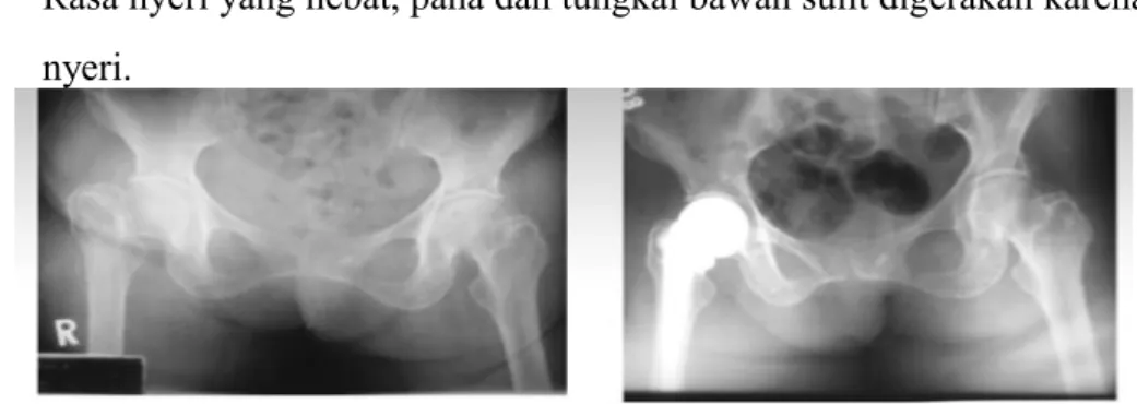 Gambar 4. Fraktur pada tulang pinggul Fraktur radius distal 
