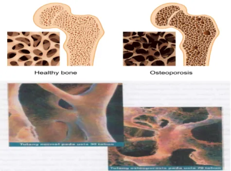 Gambar 1. Tulang normal dan tulang keropos
