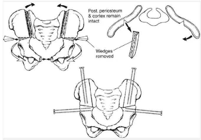 Gambar 6. Kombinasi antara osteotomi tulang panggul transversal anterior dan anterior  vertical iliaca dengan penempatan pin dan perlindungan posterior periosteum dan kortex.