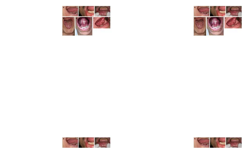 Gambar 10. Mukositis yang meluas dari sisi lateral ventral lidah Mukositis yang meluas dari sisi lateral ventral lidah diinduksi oleh kemoterapi (mukosa tidak 