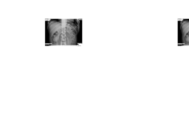 Gambar 3.4 Foto polos abdomen posisi supine (dilatasi usus)
