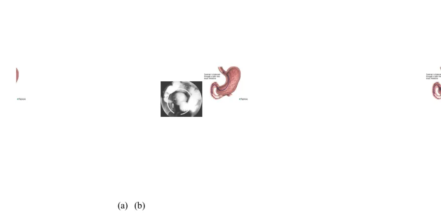 Gambar 3.8. (a). adhesional small bowel obstruction. Menunjukan gambaran lumen usus yang menyempit (tanda anak panah) (b)
