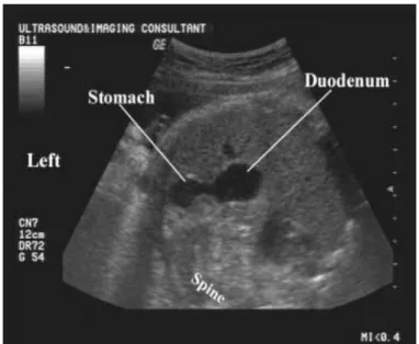 Gambar 4. Gambaran USG prenatal pada atresia duodenal  Post natal 