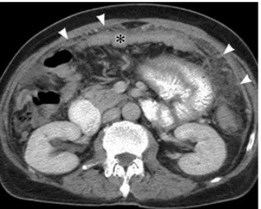 Gambar 2. CT-Scan dengan kontras menunjukkan omentum caking dan penebalan usus  halus