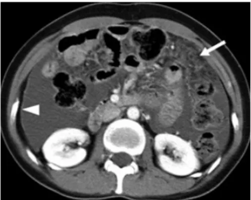 Gambar 3. CT-Scan menunjukkan sejumlah besar cairan asites dengan penebalan  peritoneum dan infiltrasi difus omentum tanpa limfadenopati