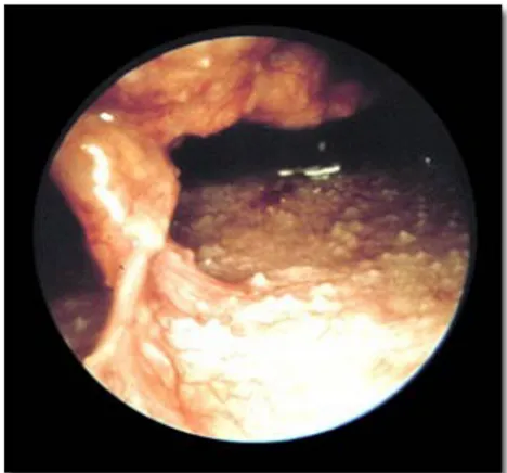 Gambar 4. Tuberkulosis Peritonitis pada Laparaskopi. 13 Gambaran yang dapat dilihat pada Tuberkulosis peritonitis :  1