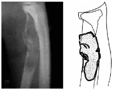Gambar 2. Fraktur patologik karena lesi displasia fibrosa pada radius proksimal (8)