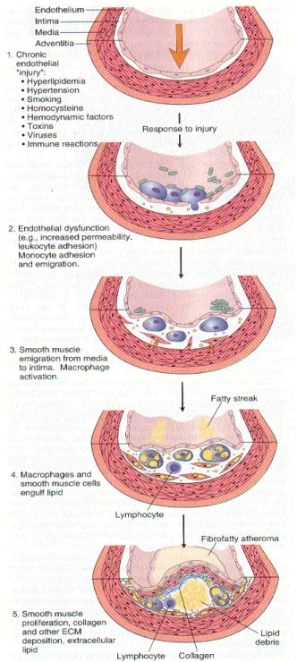 Gambar  2.  Perubahan-perubahan dinding arteri pada ‘hipotesis respons terhadap cedera’