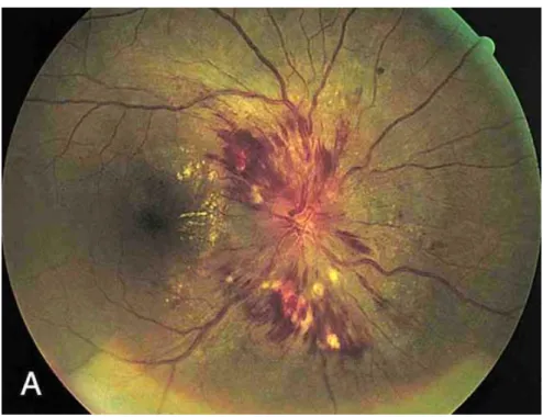 Gambar  03.  Papiledema.  Perhatikan  adanya  pembengkakan  dari  optik  disc  dengan margin kabur