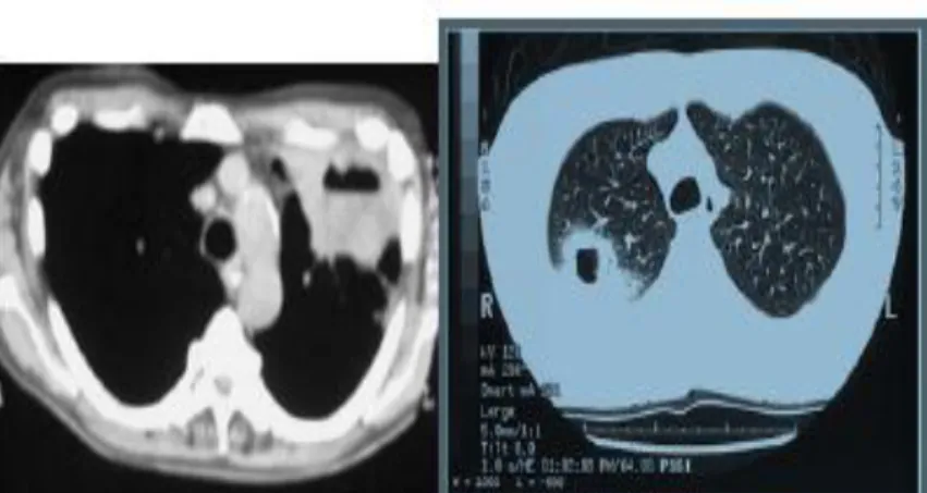 Gambar 3. Gambaran abses paru dengan CT-scan. CT memperlihatkan kavitasi pada lobus atas  paru kiri dengan jelas (kiri)