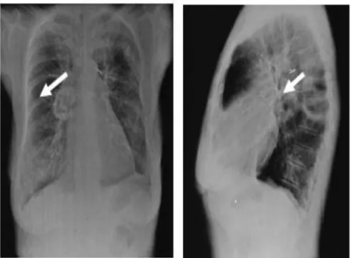 Gambar 1. Foto X-Ray ini ditemukan kavitas pada hilum kanan. Foto X-ray posisi lateral  memperlihatkan kavitas memiliki dinding yang tipis dan terletak pada segmen apikal dari lobus 