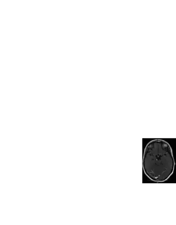 Gambar  4.  MRI  dengan  kontras gadolinum,  pada  potongan  aksial  T2 FLAIR terdaoat penyangatan pada fase akut  OM
