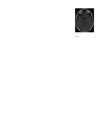 Gambar  5.  MRI  ulang  pada  potongan aksial  T2  FLAIR  dengan  kontras gadolinum 10 minggu setelah episode serangan dan setelah resolusi komplit.