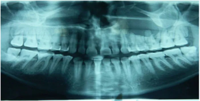 Gambar 2 pra operasi orthopantomograph.