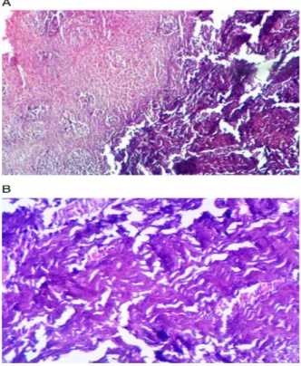 Gambar 3 (A) pola epitel dan (B) kronis arcading sel-sel inflamasi.