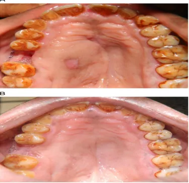 Gambar 5 (A) pasca operasi setelah 15 hari dan (B) pascaoperasi setelah 6 bulan.