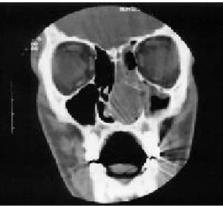 Gambar 2. Penampang koronal CT scan yang memperlihatkan adanya lesi angiofibroma yang mengisi  cavum nasal kiri dan sinus ethmoid, memenuhi sinus maksilaris dan menyebabkan deviasi septum nasi 