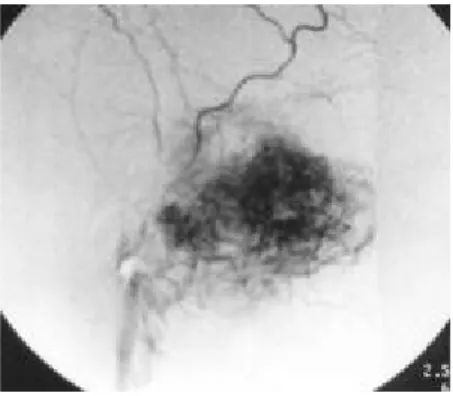Gambar 3. Gambaran angiogram yang memperlihatkan adanya angifibroma sebelum embolisasi