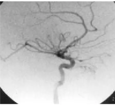 Gambar 4. Gambaran angiogram yang memperlihatkan adanya angifibroma setelah embolisasi