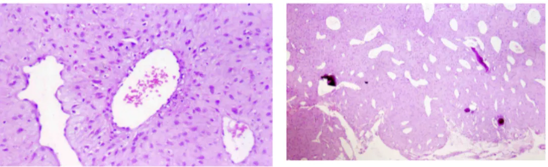 Gambar 5. Gambaran histopatologi angiofibroma nasofaring