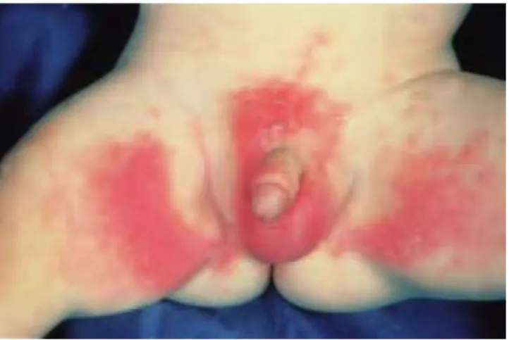 Gambar 1. Dermatitis popok iritan primer. 3 