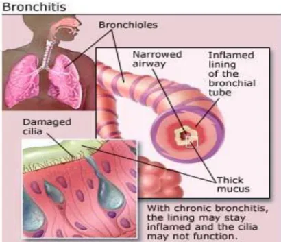 Gambar 3: Patogenesis Bronkitis Akut 