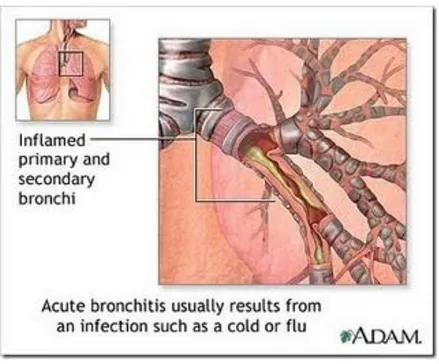 Gambar 1. Bronkitis akut  (Sumber: ADAM) 