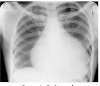 Gambar 1 : Cardiomegaly 2. Penyakit jantung koroner