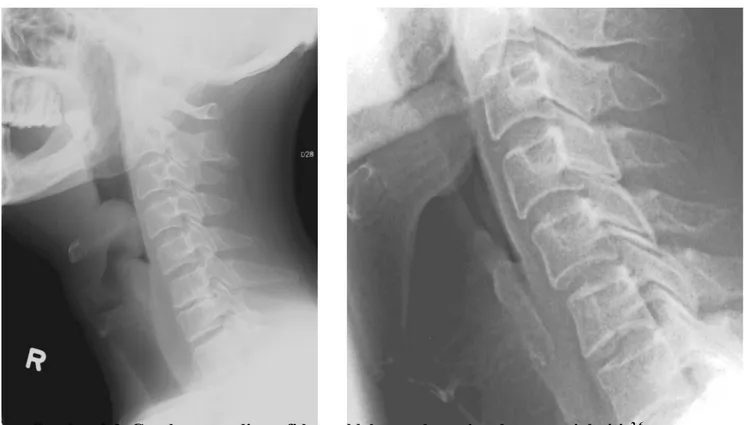 Gambar 2.3. Gambaran radiografi lateral leher pada pasien dengan epiglotitis 2,6
