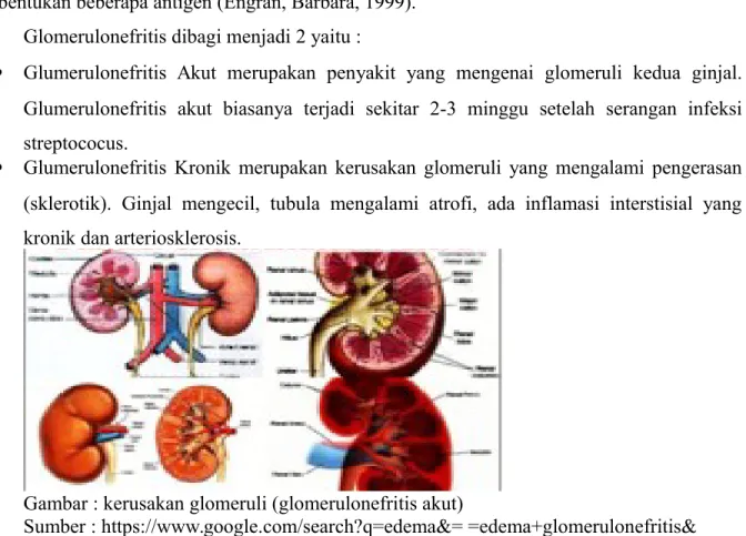 Gambar : kerusakan glomeruli (glomerulonefritis akut) 